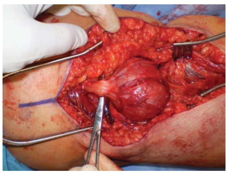 Popliteal Schwannoma.png